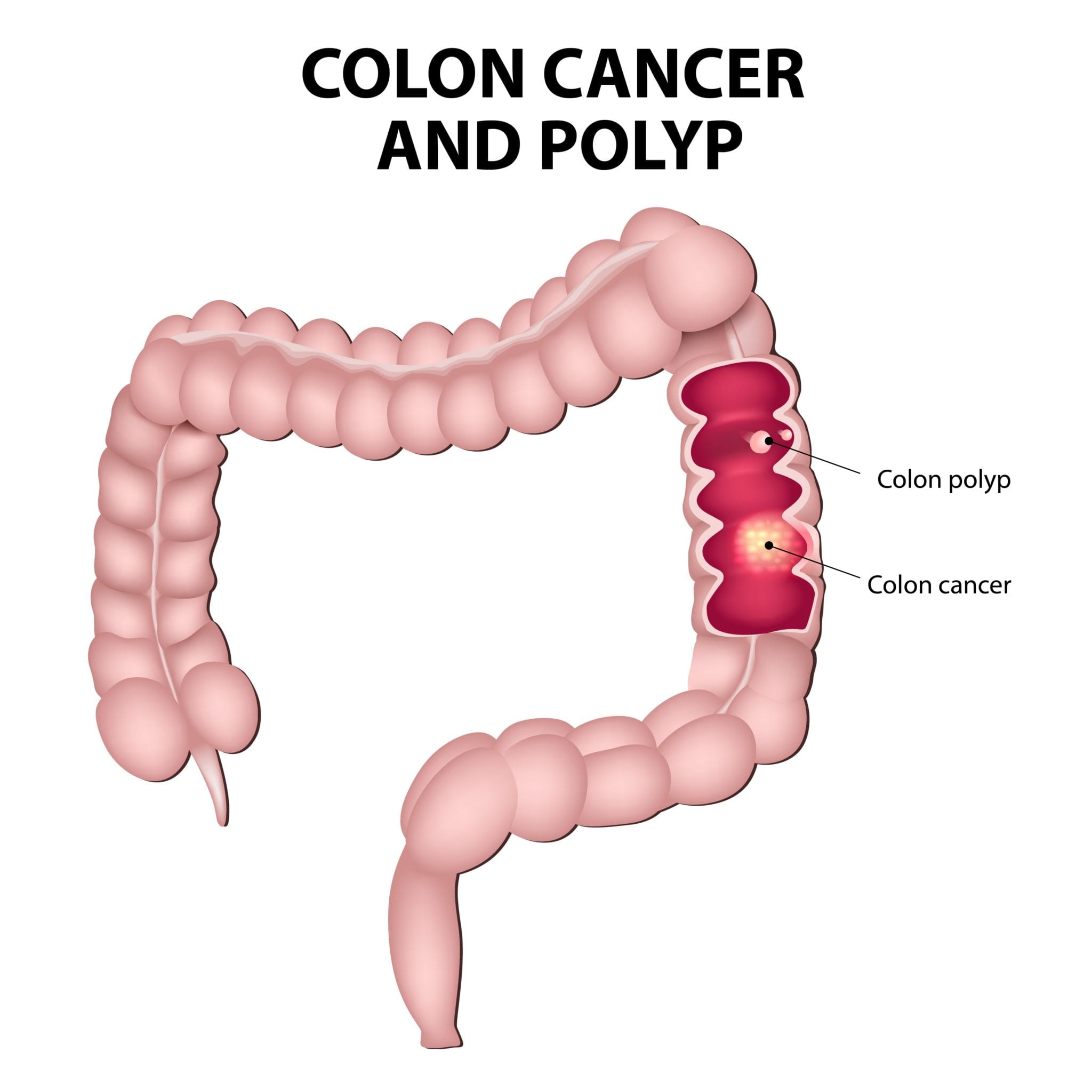 Colon Polyps and Treatment